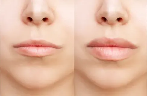 Elena Geller's before and after simulation