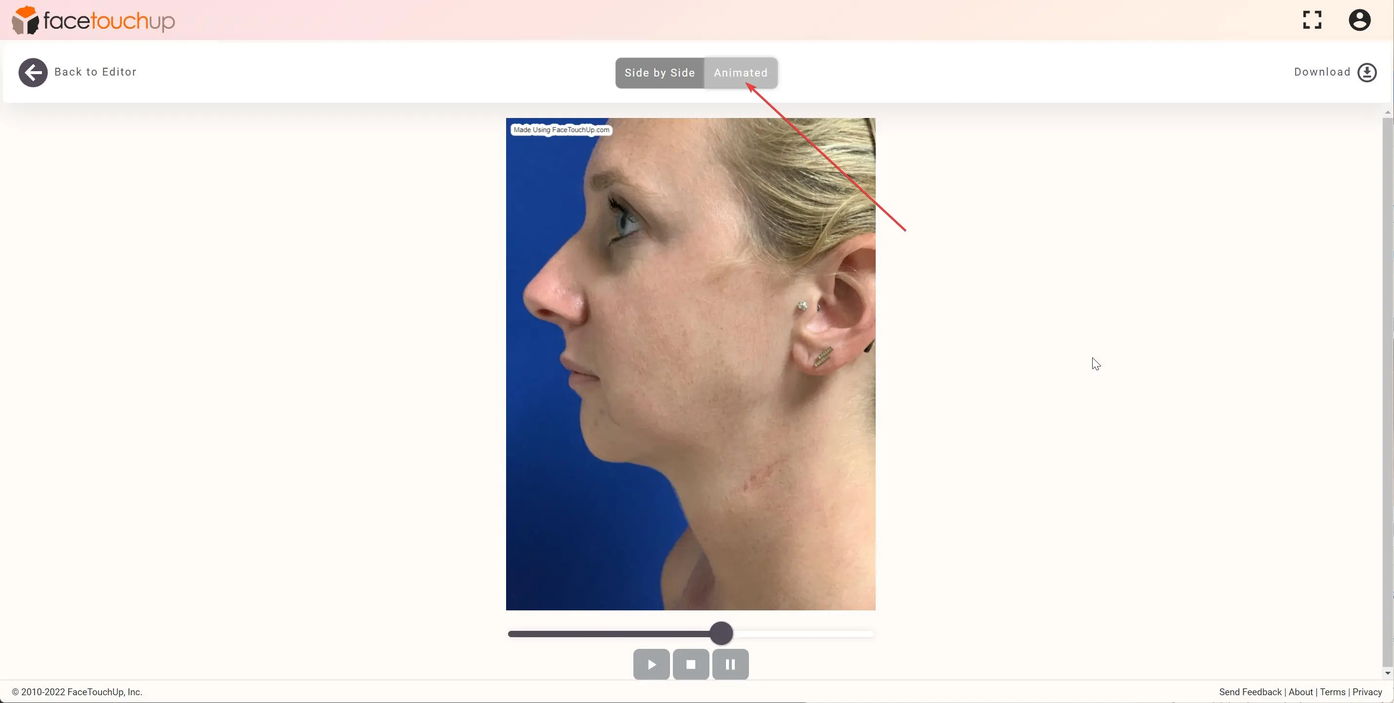 FaceTouchUp chin and neck lift simulation - After result comparison