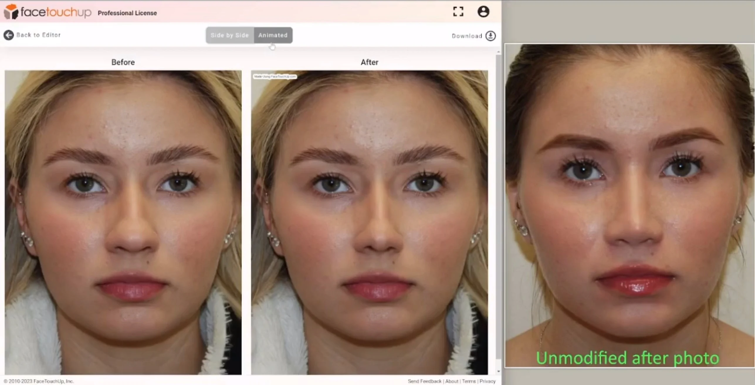 front view rhinoplasty real and AI simulated results