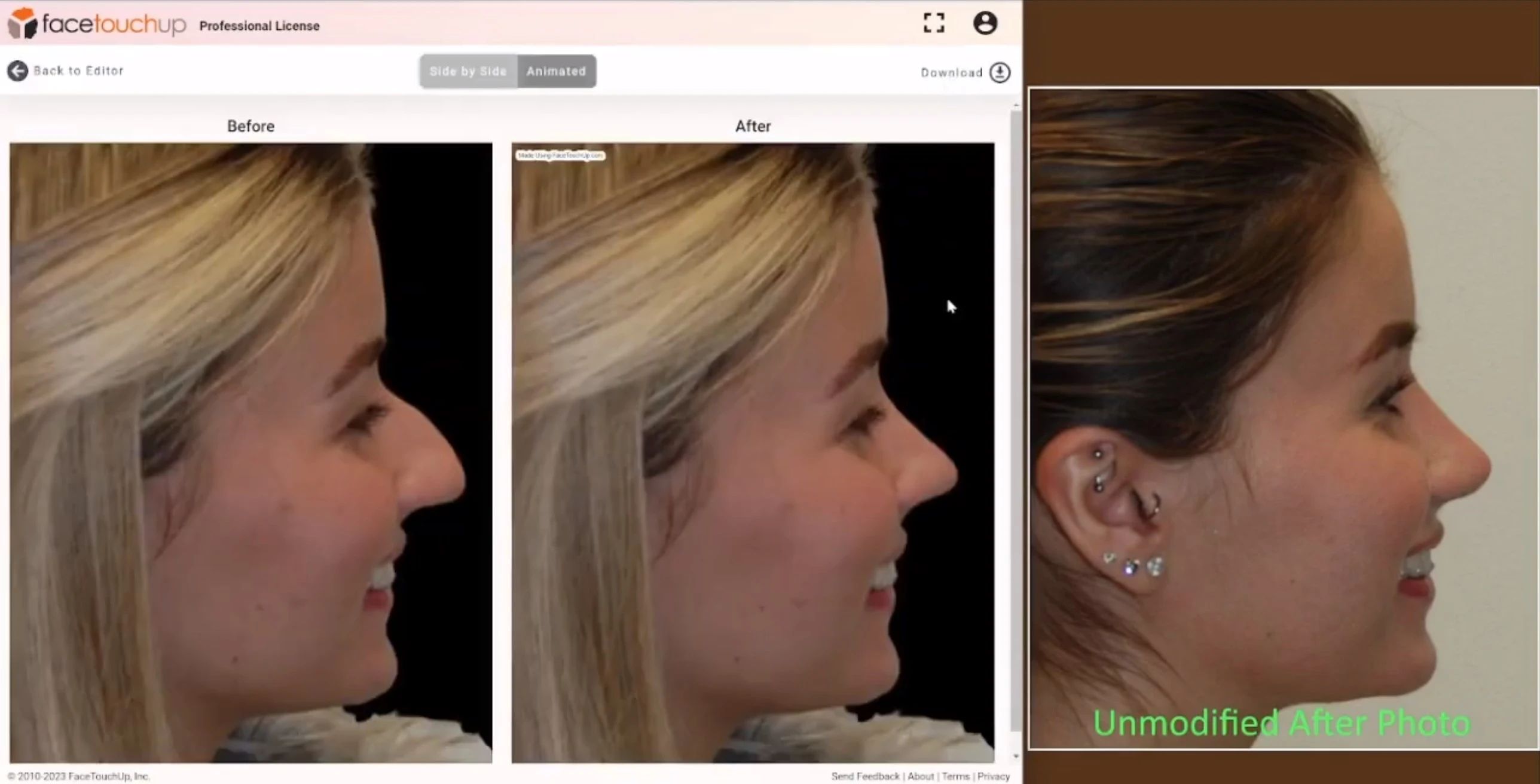 profile rhinoplasty real and AI simulated results