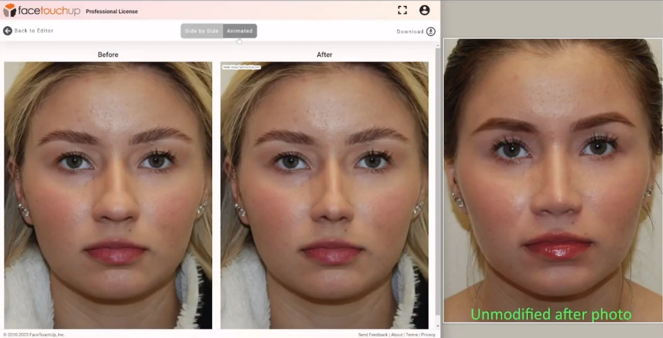 Real rhinoplasty result vs FaceTouchUp simulation - Front view comparison