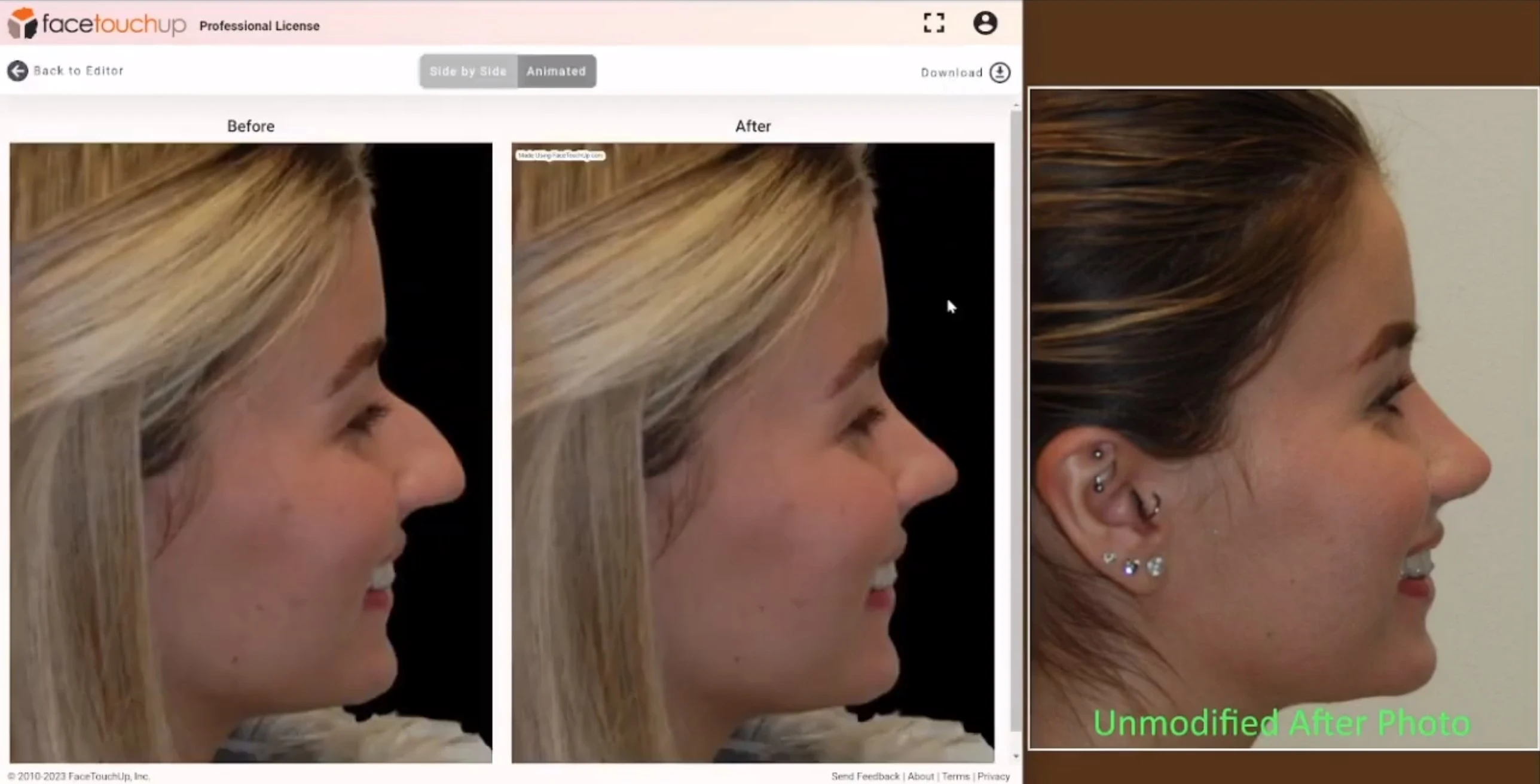 Real rhinoplasty result vs FaceTouchUp simulation - Profile view comparison